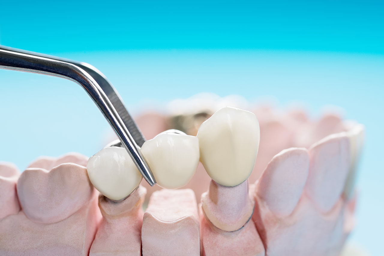 Dental Bridges in Sheffield, OH: Filling the Gap Left by Missing Teeth