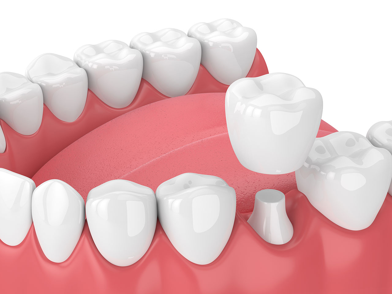 Dental Crowns in Sheffield, OH: Restoring Strength to Damaged Teeth