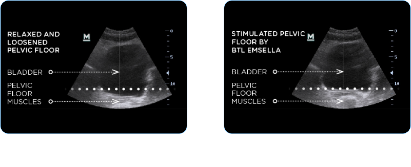 Emsella