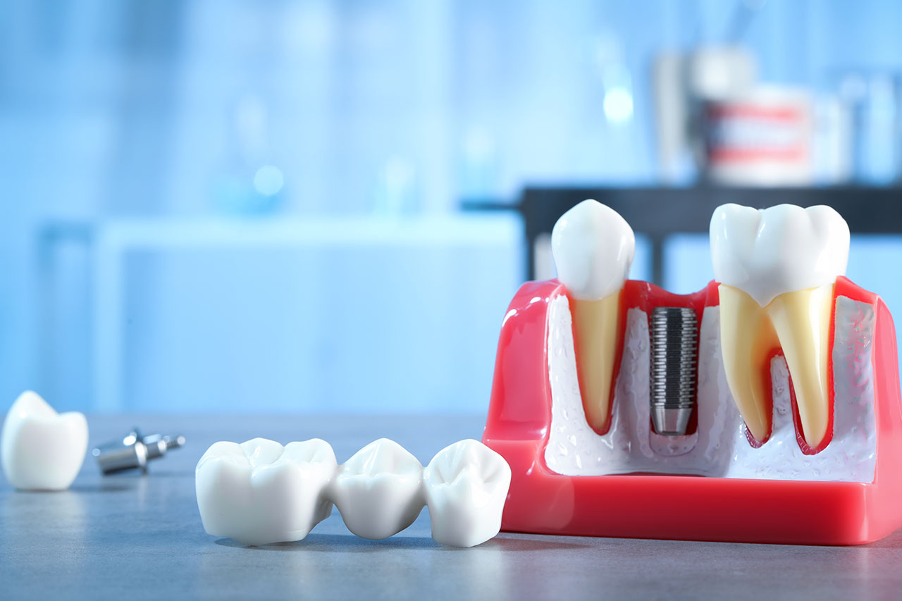 Advanced Restorative Solutions | Missing Tooth Replacement Options in Sheffield, OH: Which Solution May Be Right for You?